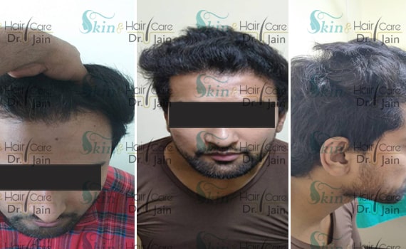 Before & After Hair Transplantation - Patient 13