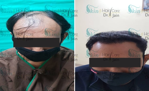 Before & After Hair Transplantation - Patient 15
