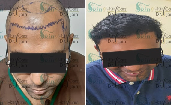 Before & After Hair Transplantation - Patient 16