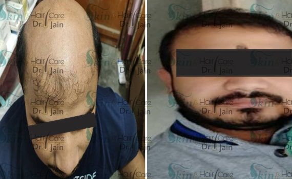 Before & After Hair Transplantation - Patient 19