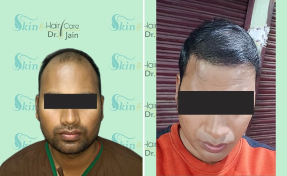 Before & After Hair Transplantation - Patient 2