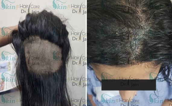Before & After Hair Transplantation - Patient 21