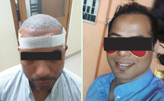 Before & After Hair Transplantation - Patient 3