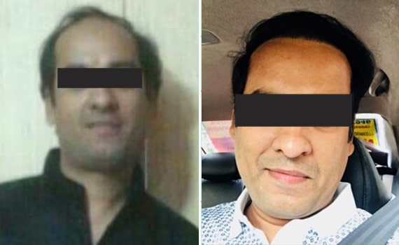 Before & After Hair Transplantation - Patient 5